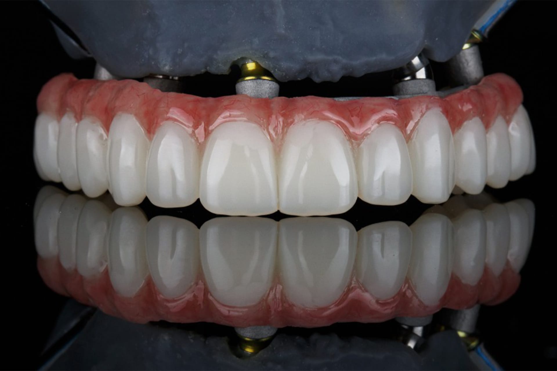 All-on-X Dental Implants Procedure